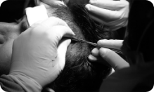 FUE TECHNIQUE